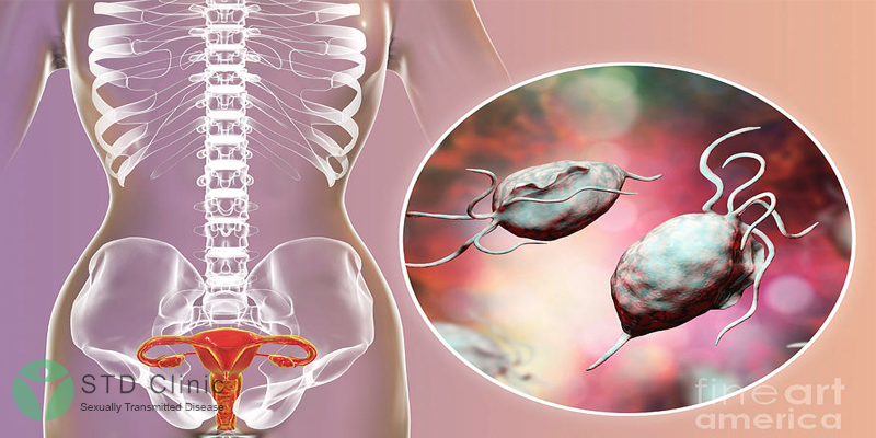 Nhiễm trùng roi – Trichomoniasis